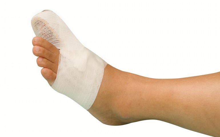 Skadet stortå - © www.colourbox.com Skadet stortå